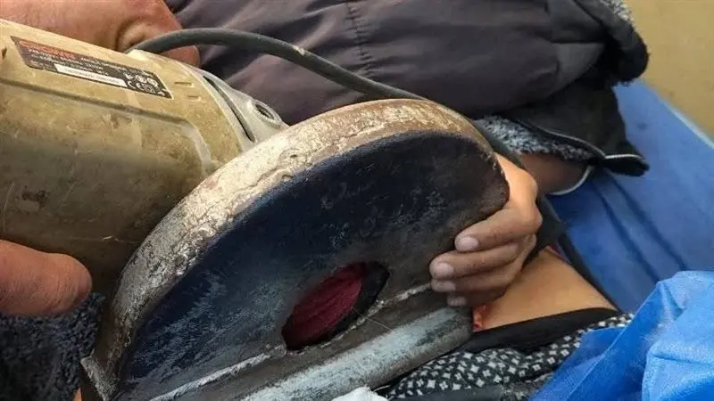 معجزة طبية في دمياط.. كيف نجح أطباء الأزهر في استخراج منشار كهربائي من بطن طفل؟