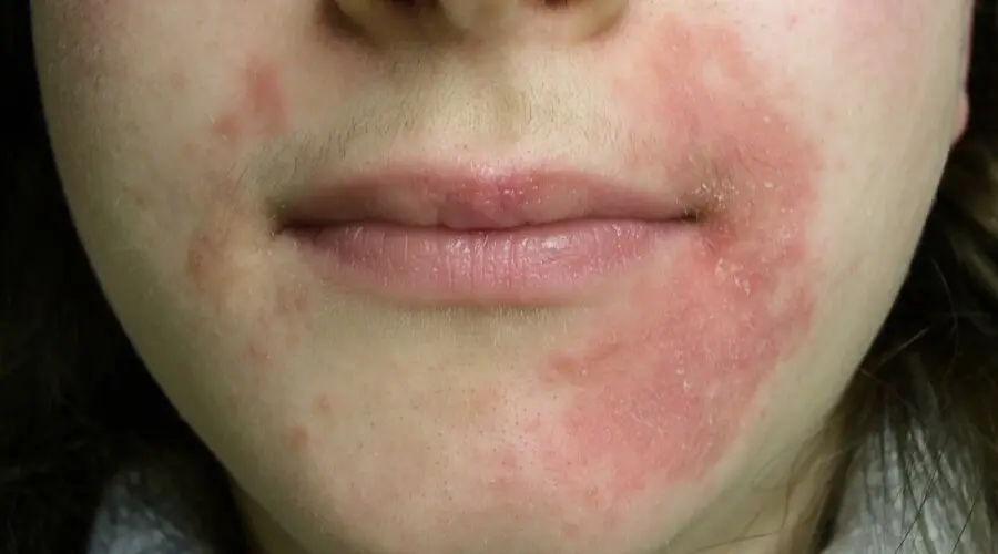 التهاب حول الشفاه.. أعراض لا يجب تجاهلها