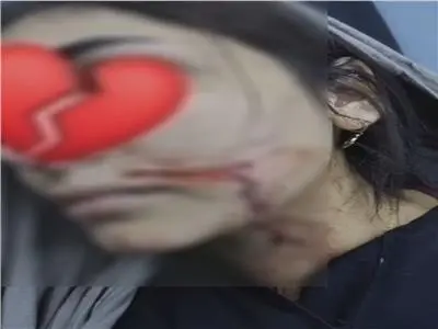 رفضت الارتباط به.. شاب يشوه وجه فتاة بـ70 غرزة في شبرا الخيمة